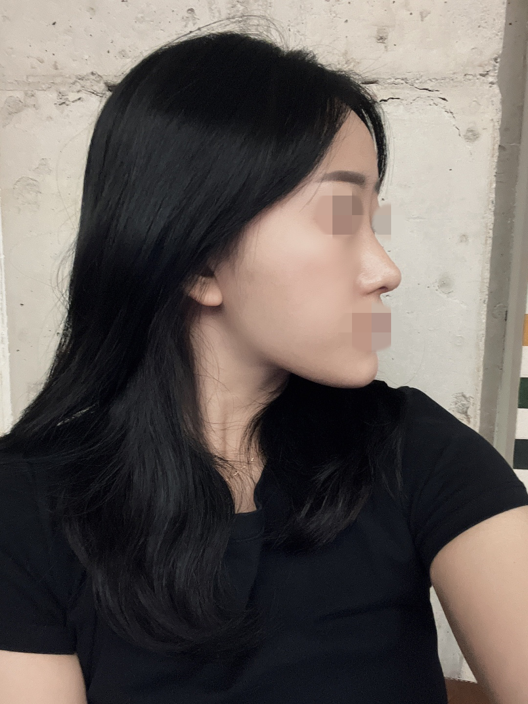 수술후기이미지