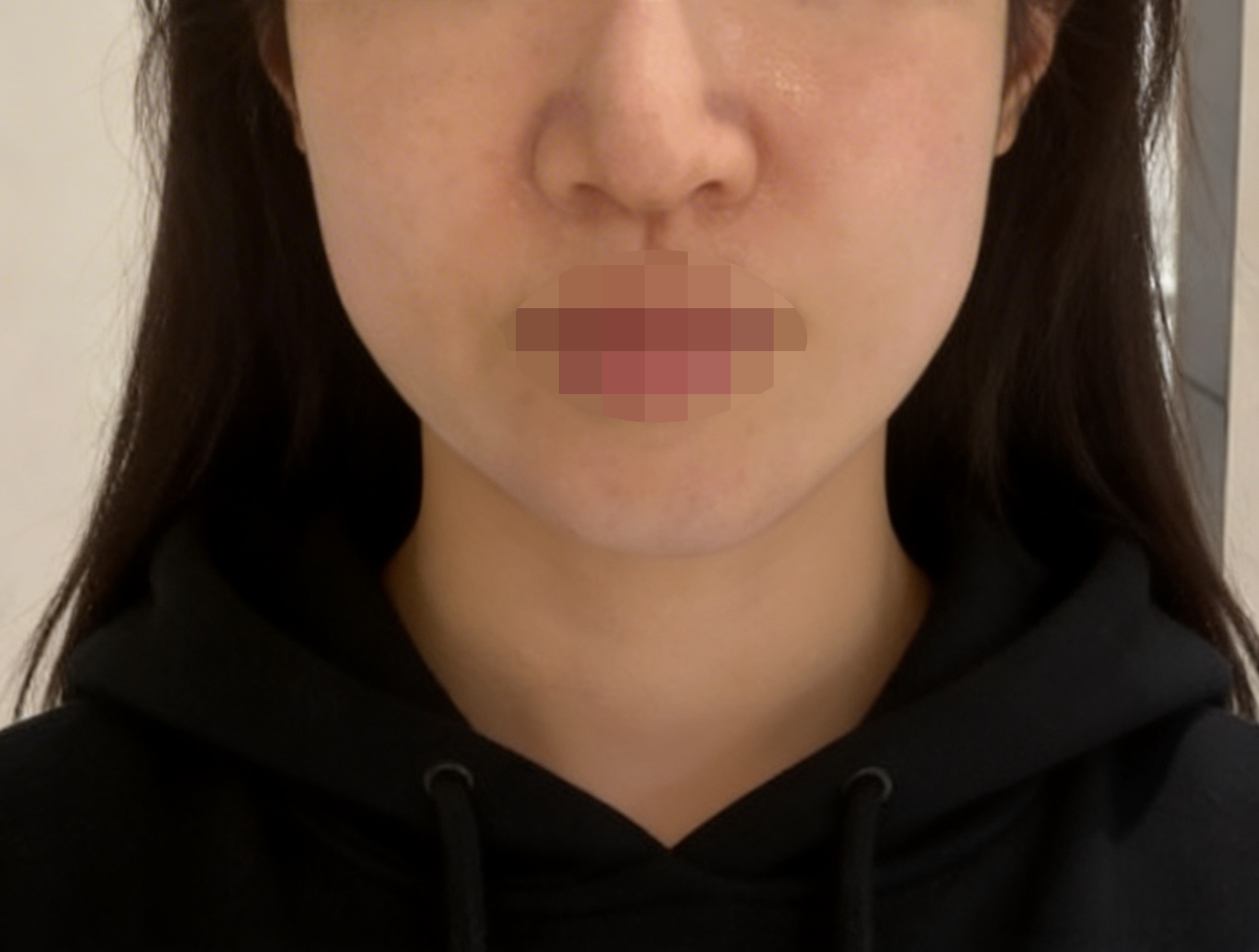 수술후기이미지