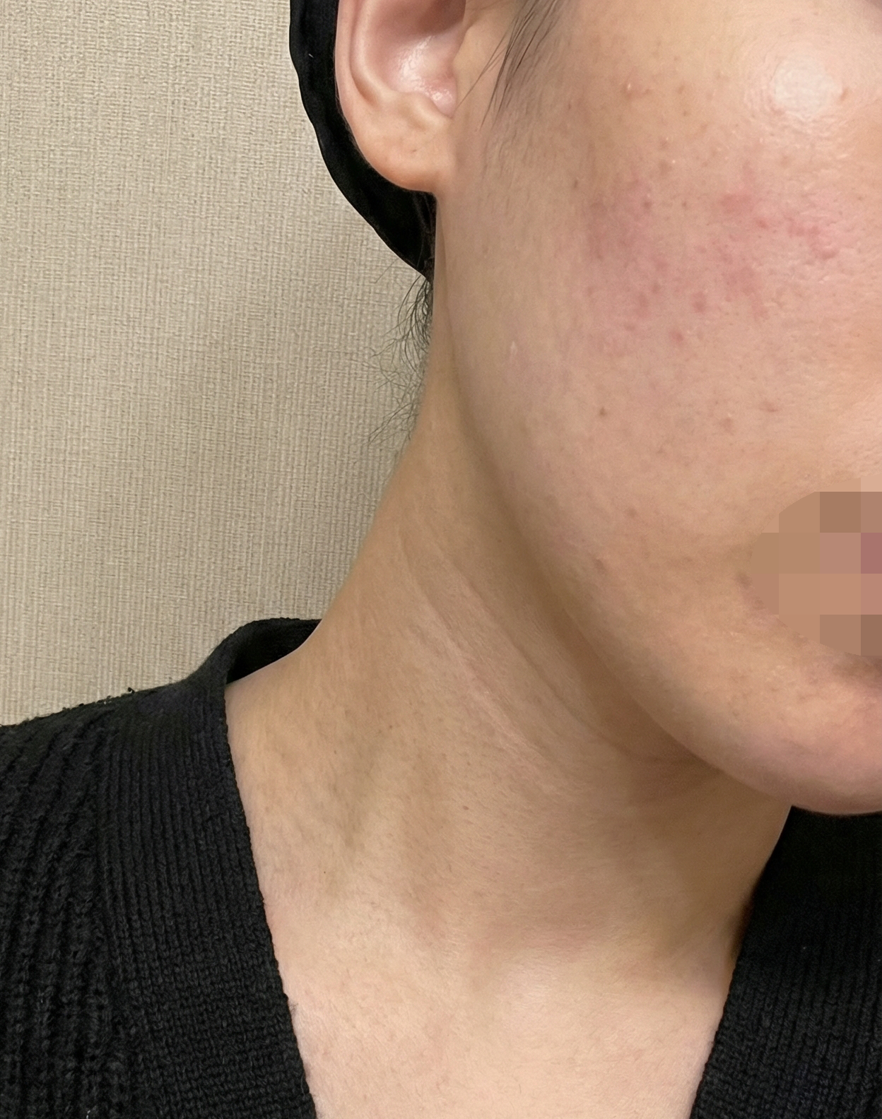 수술후기이미지