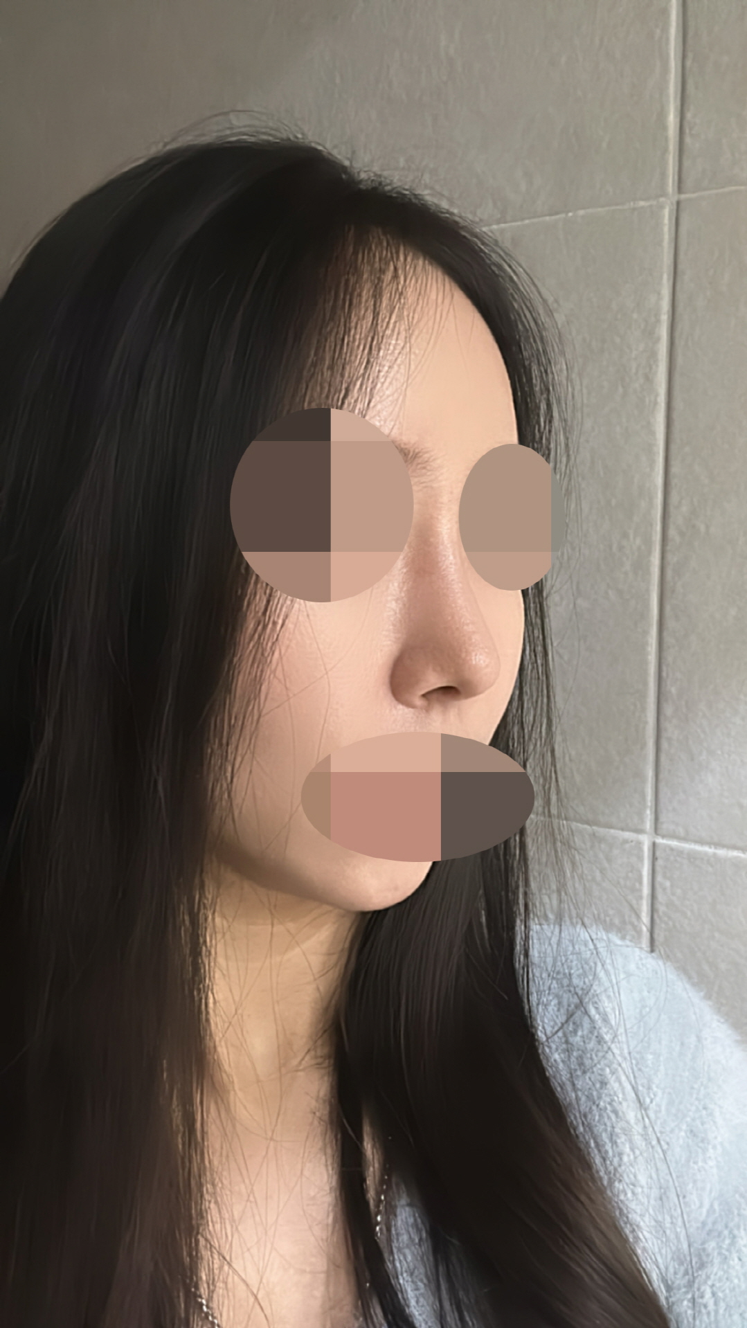 수술후기이미지