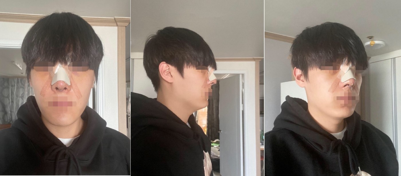 수술후기이미지