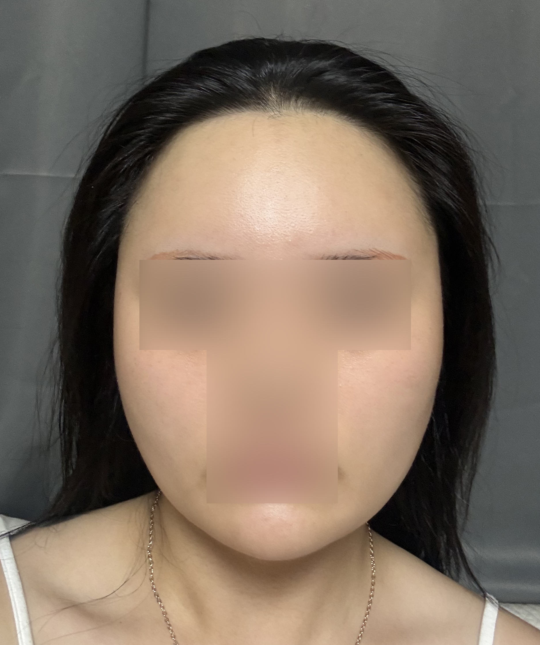수술후기이미지