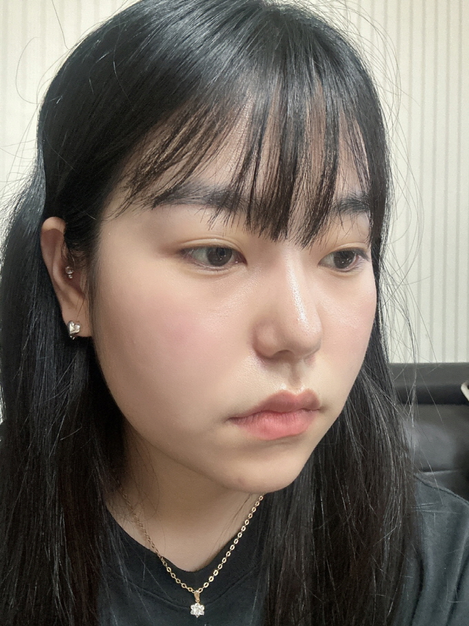 수술후기이미지