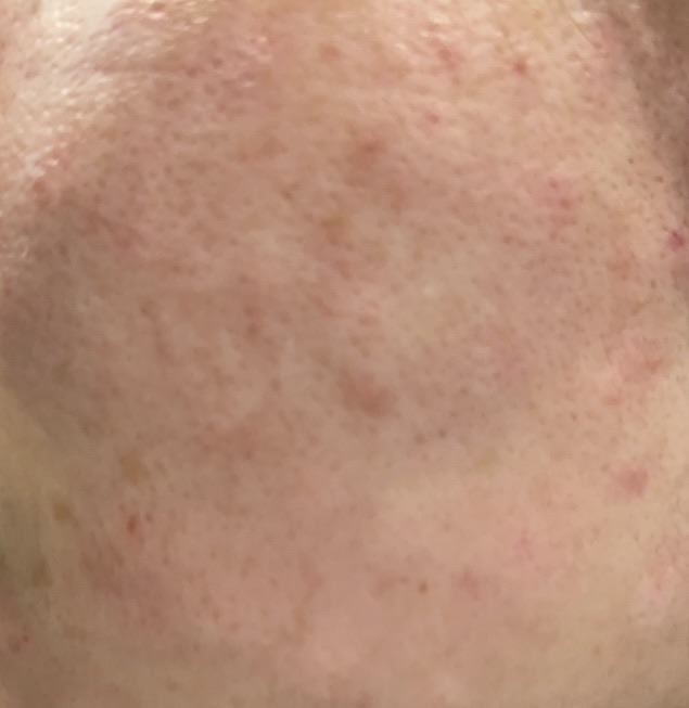 수술후기이미지