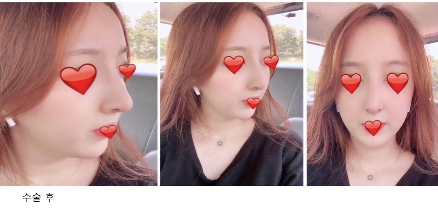 수술후기이미지