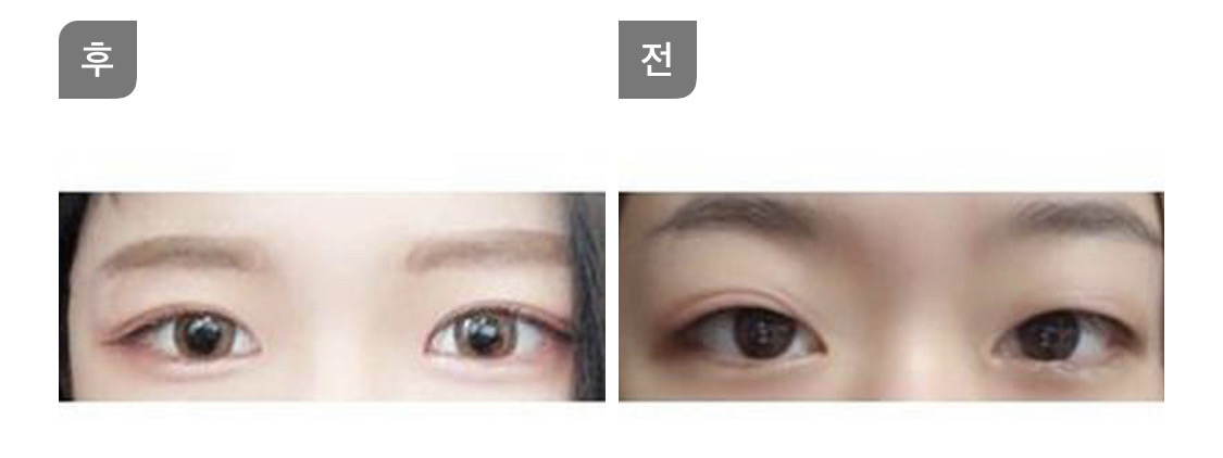 수술후기이미지