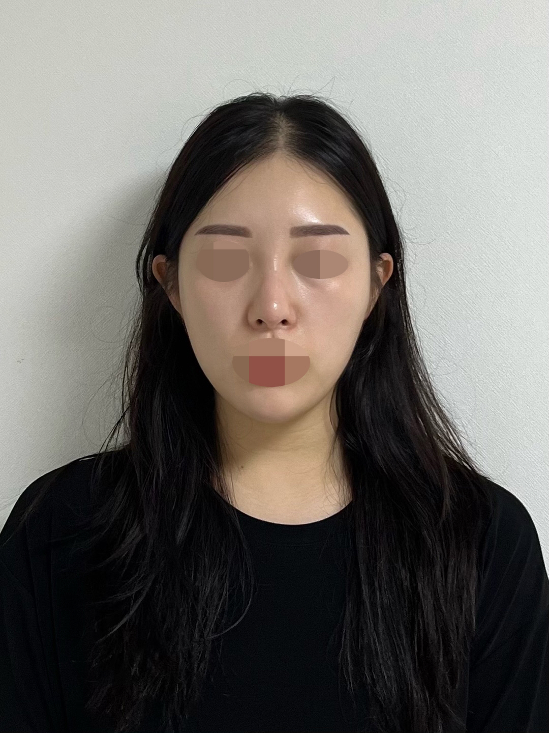 수술후기이미지