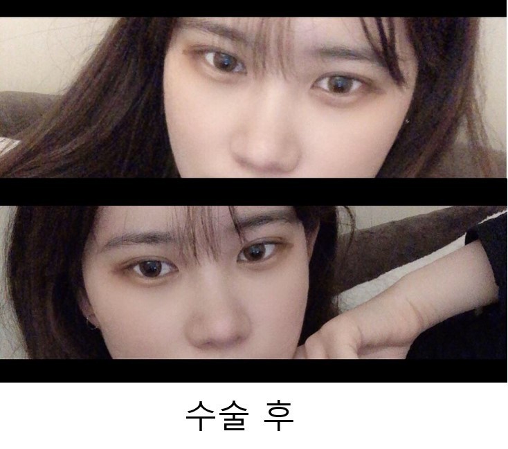 수술후기이미지