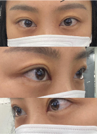 수술후기이미지