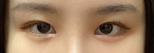 수술후기이미지