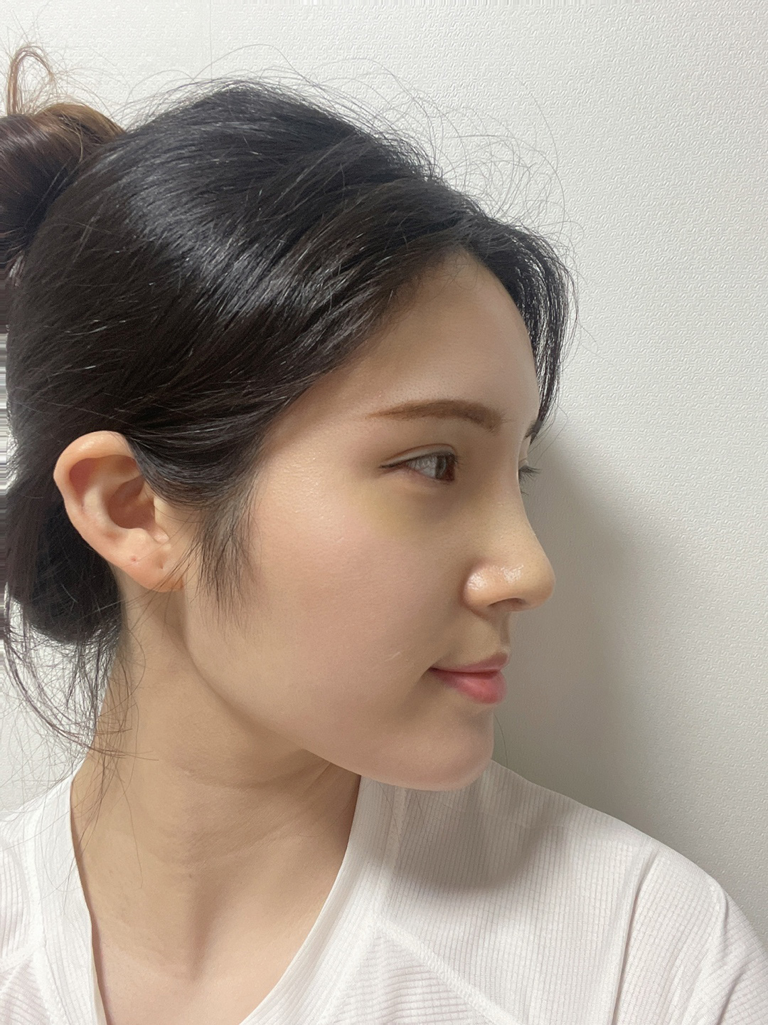 수술후기이미지