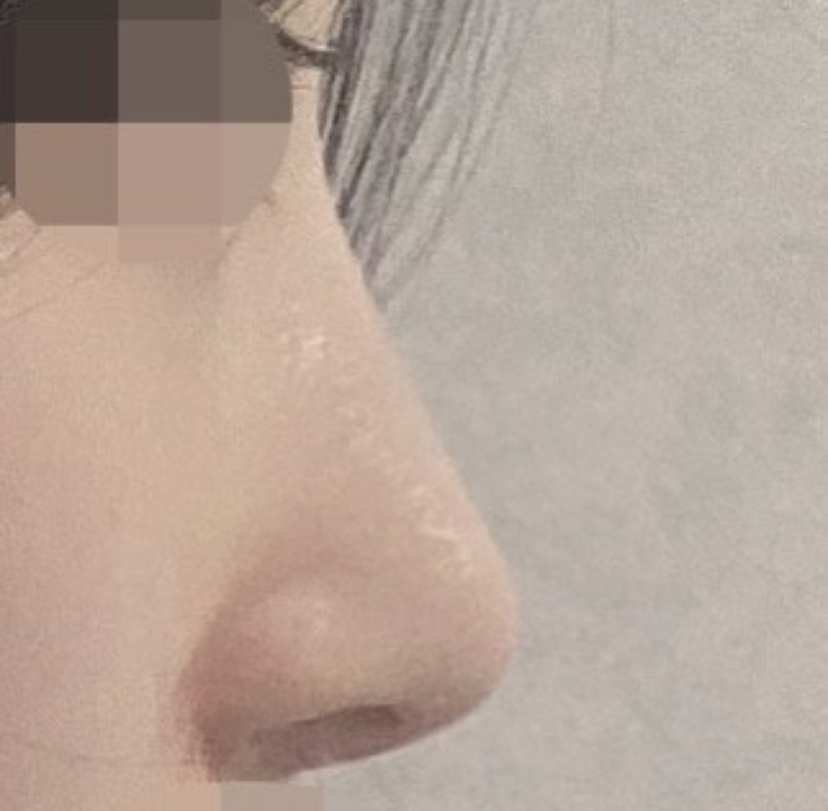 수술후기이미지