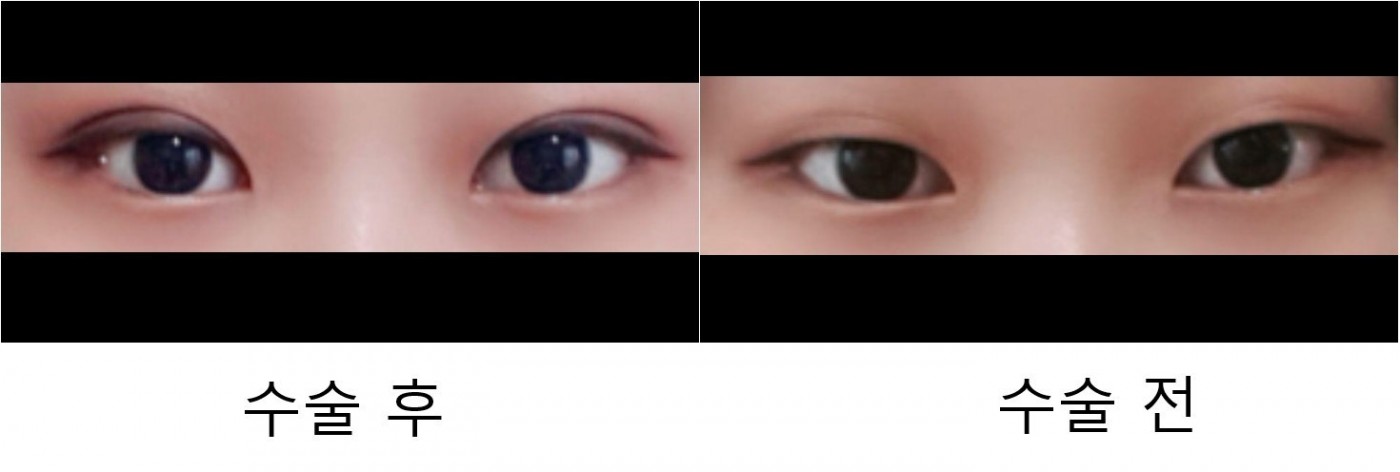 수술후기이미지