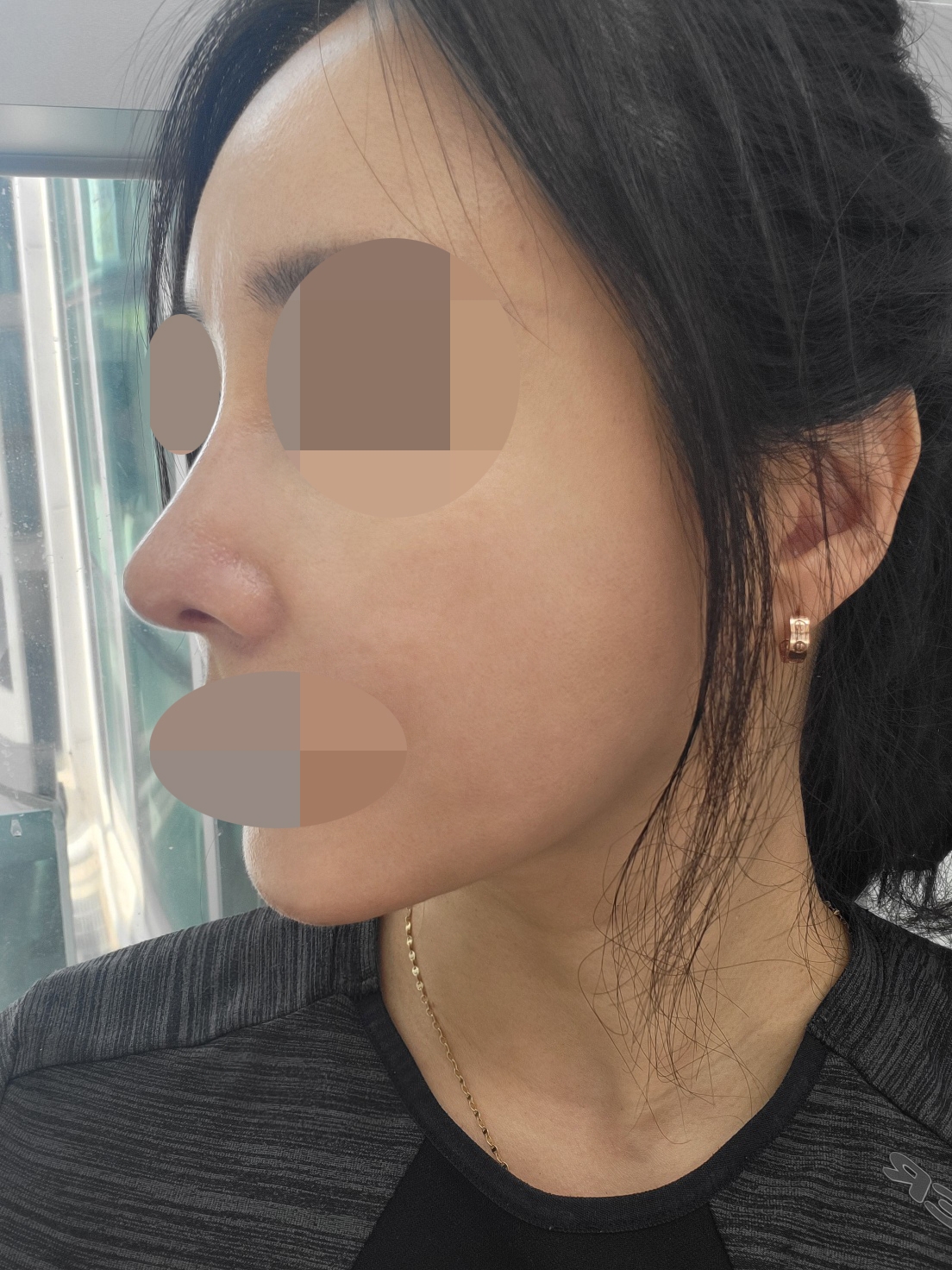 수술후기이미지