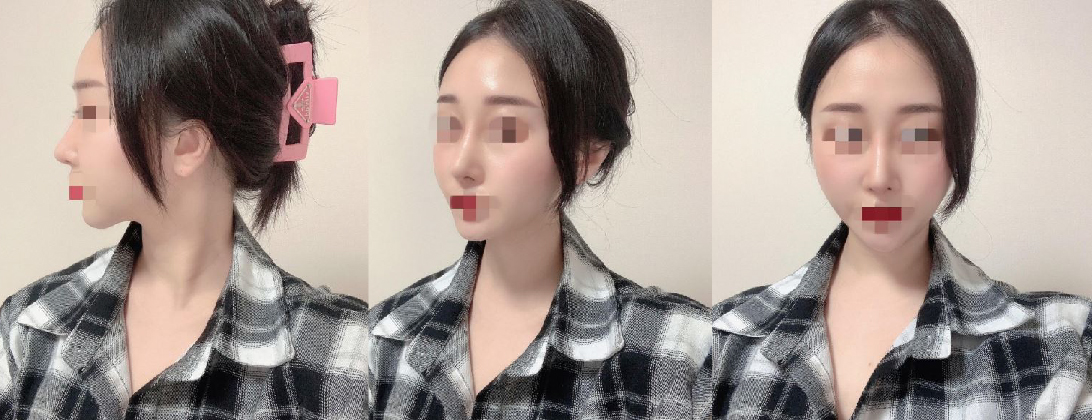 수술후기이미지