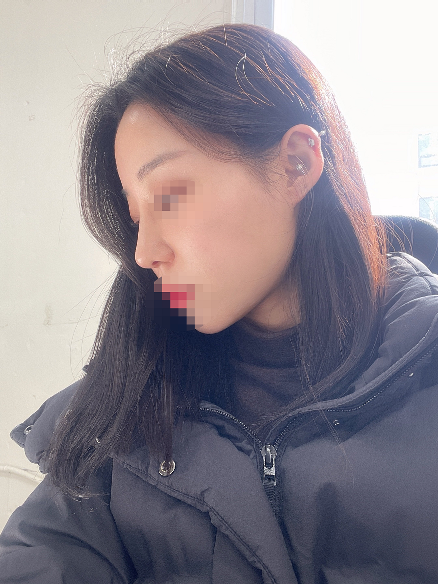 수술후기이미지