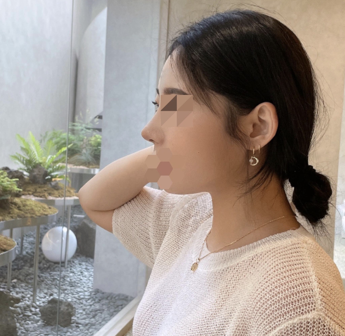 수술후기이미지