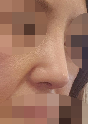 수술후기이미지