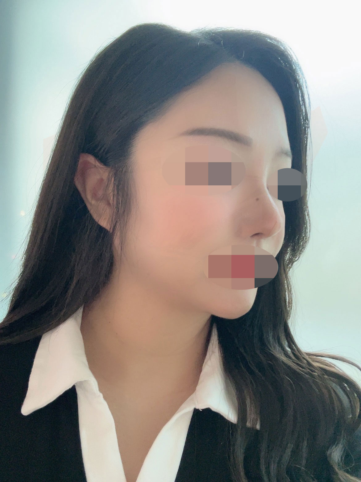 수술후기이미지