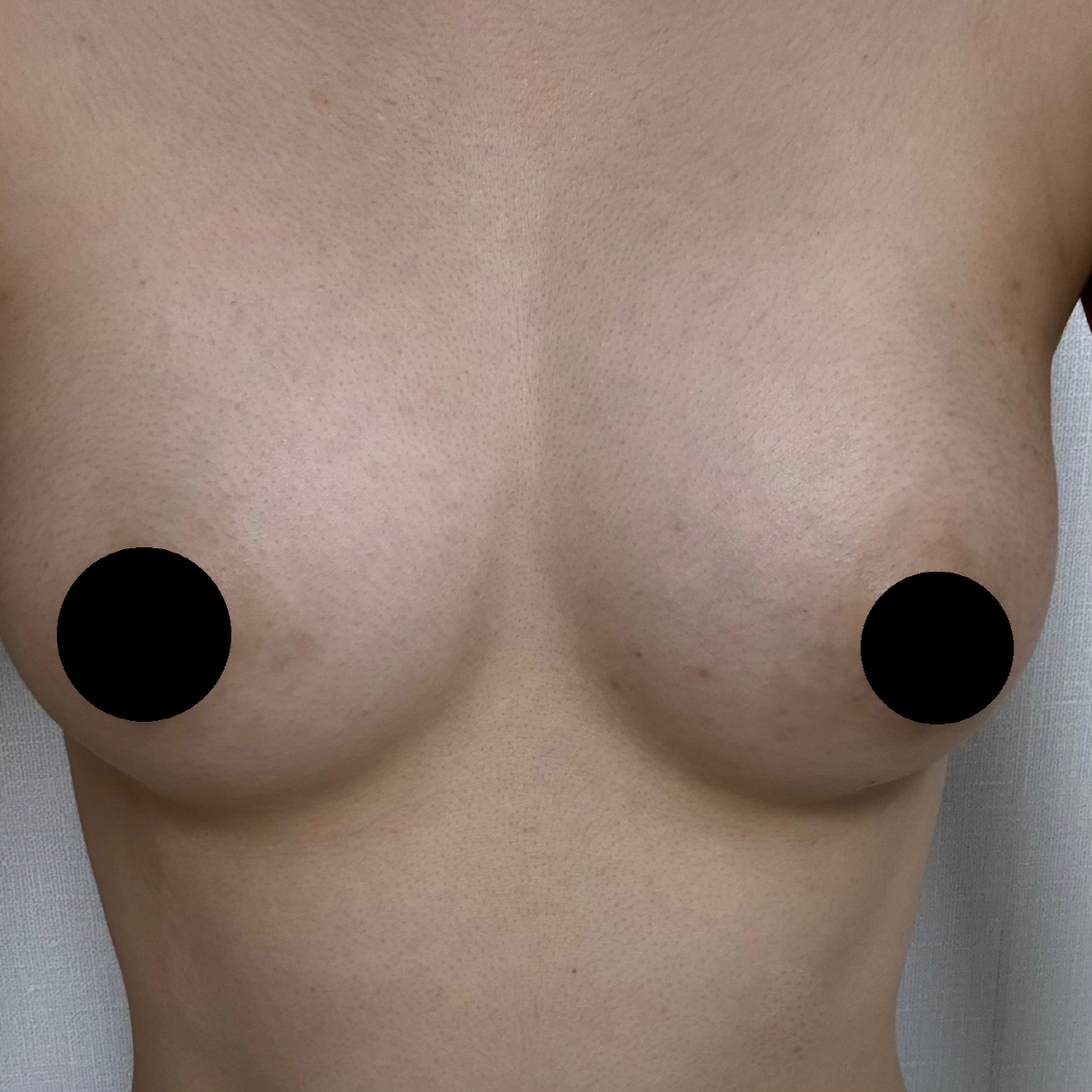 수술후기이미지