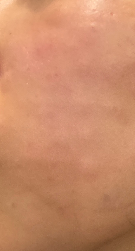 수술후기이미지