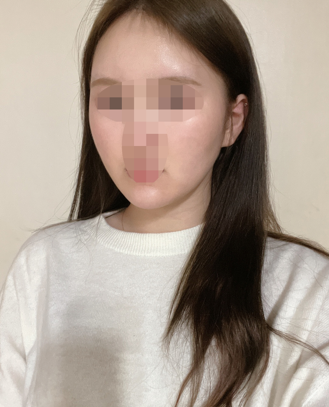 수술후기이미지