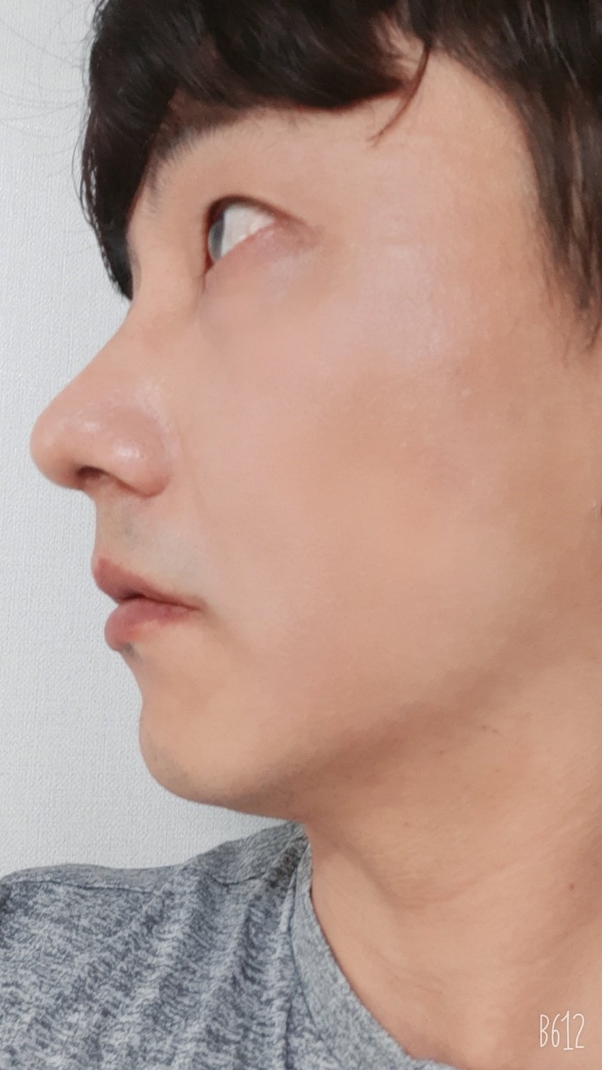 수술후기이미지