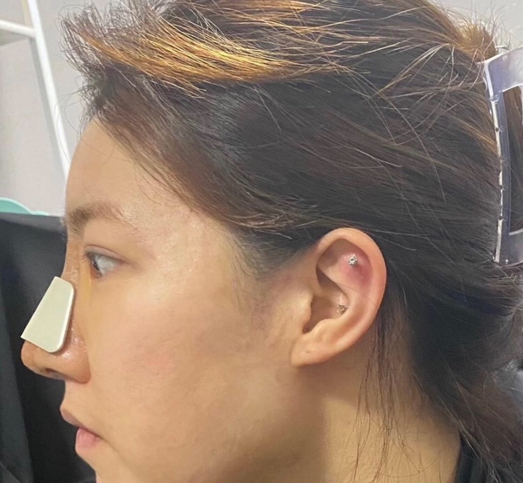 수술후기이미지