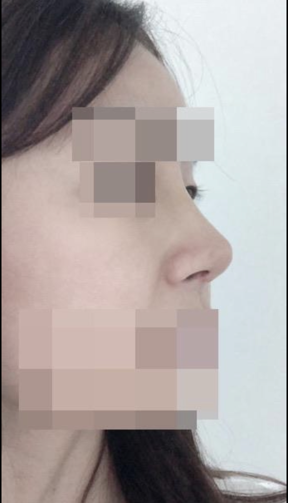 수술후기이미지