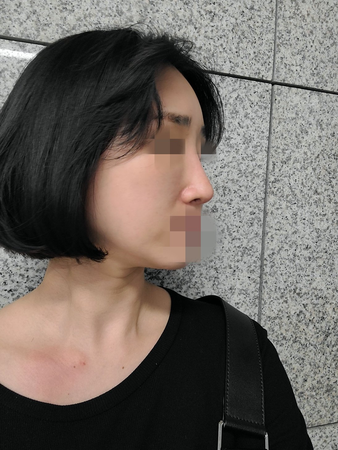 수술후기이미지