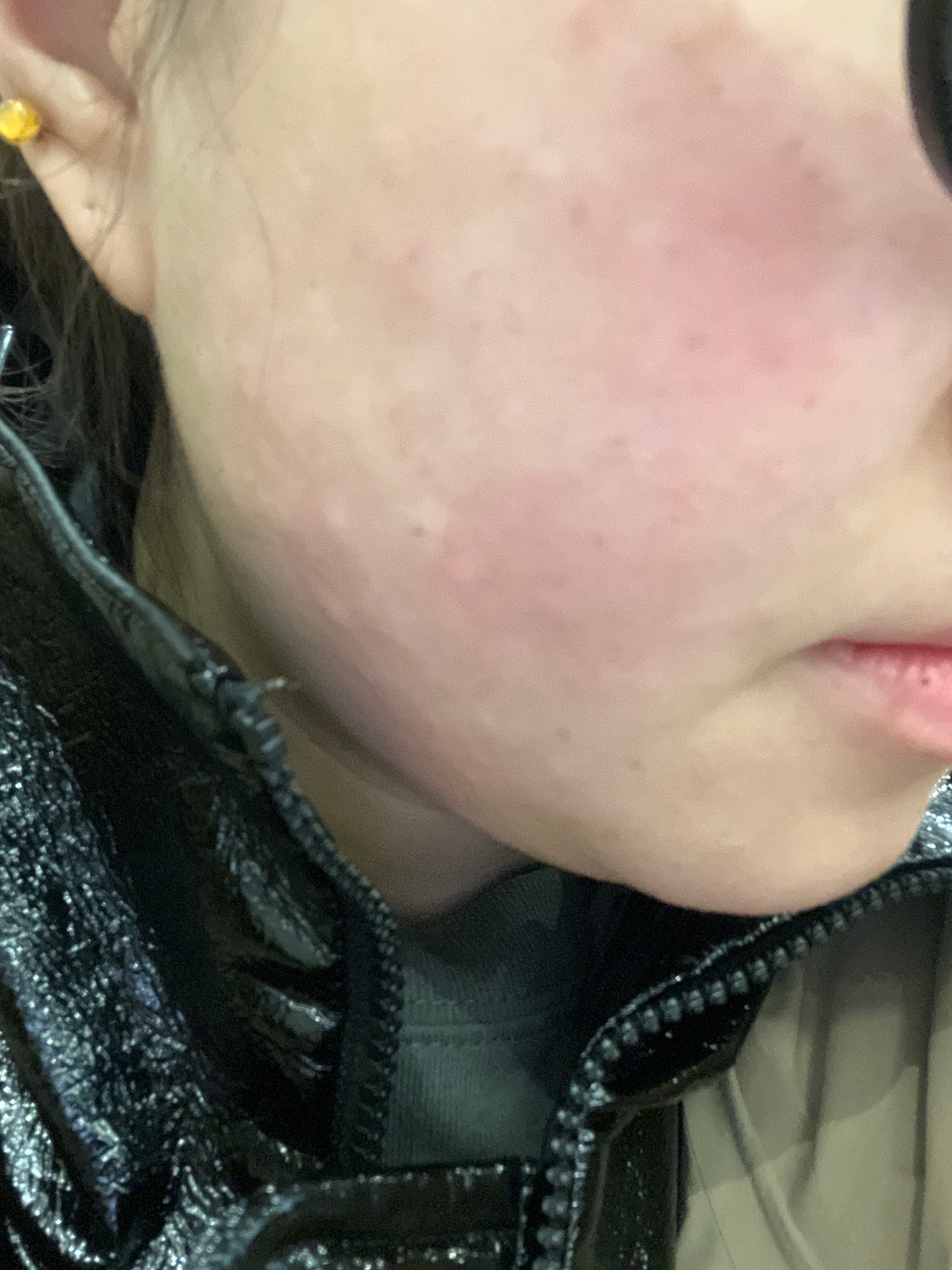 수술후기이미지