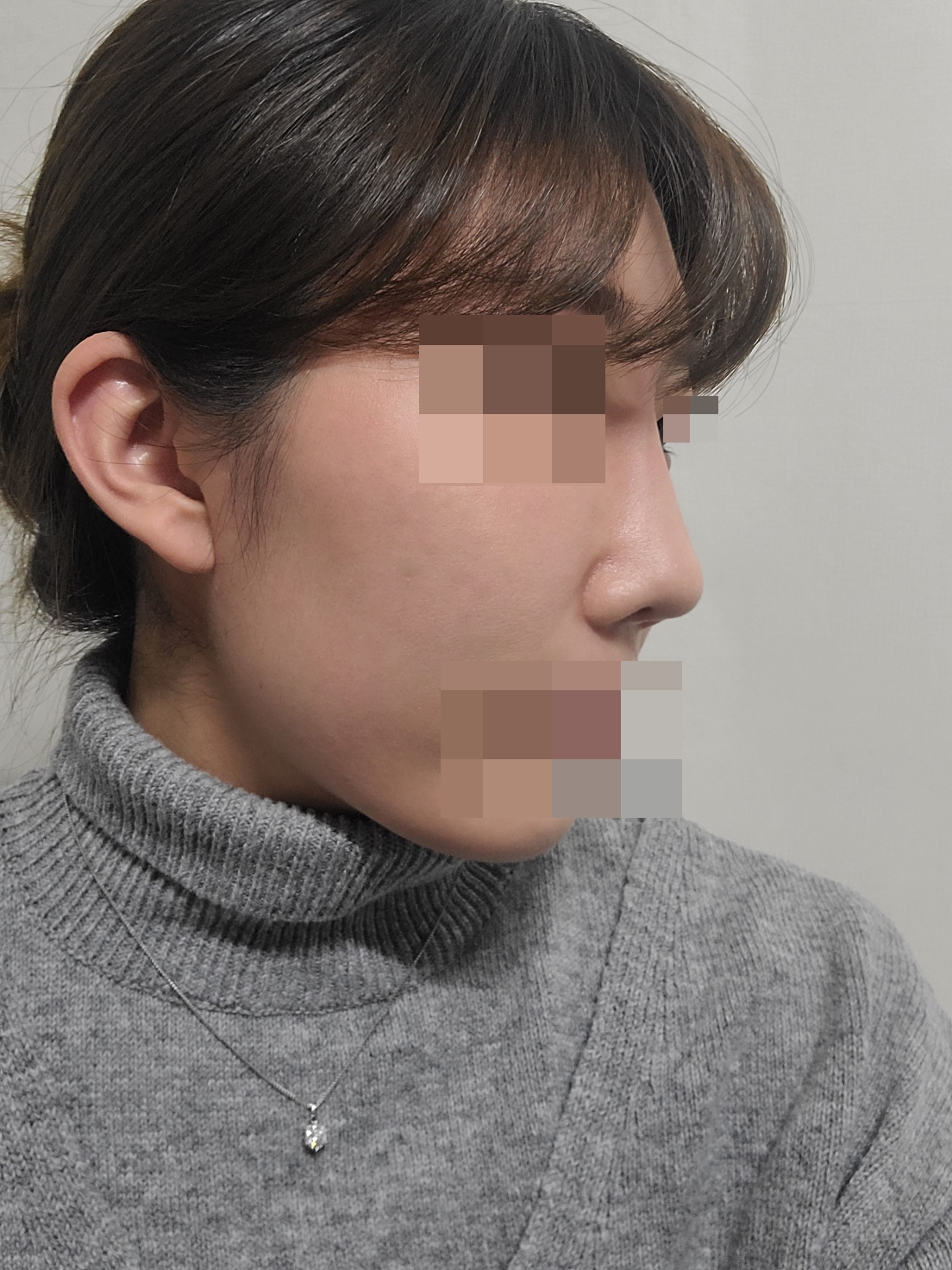 수술후기이미지