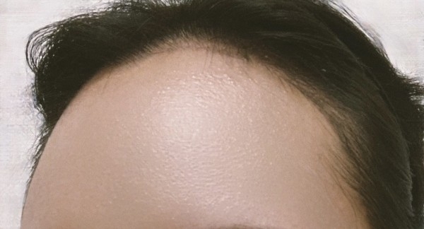 모발이식 수술후 2주차이고 헤어라인 교정을 하기 위해 수술 받게 됐습니다.