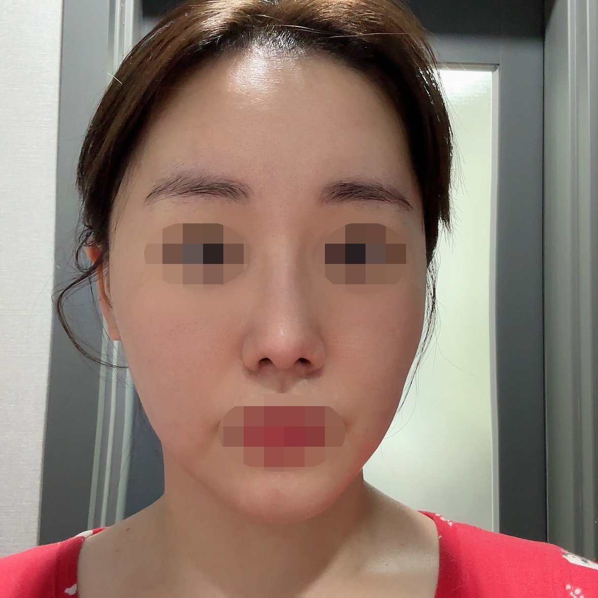 수술후기이미지