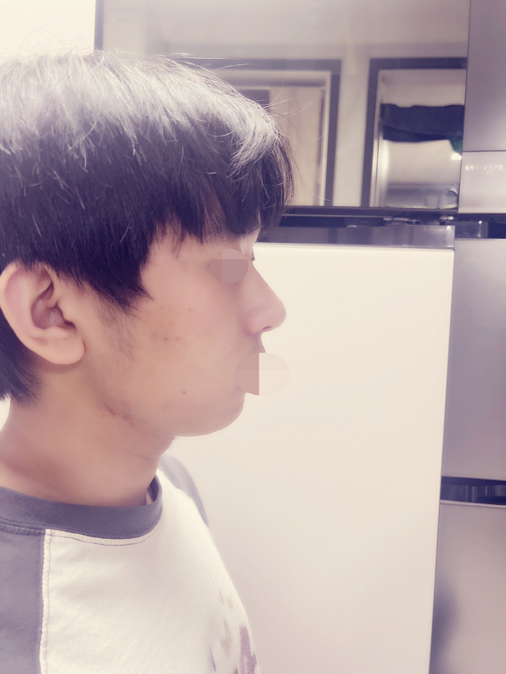 수술후기이미지