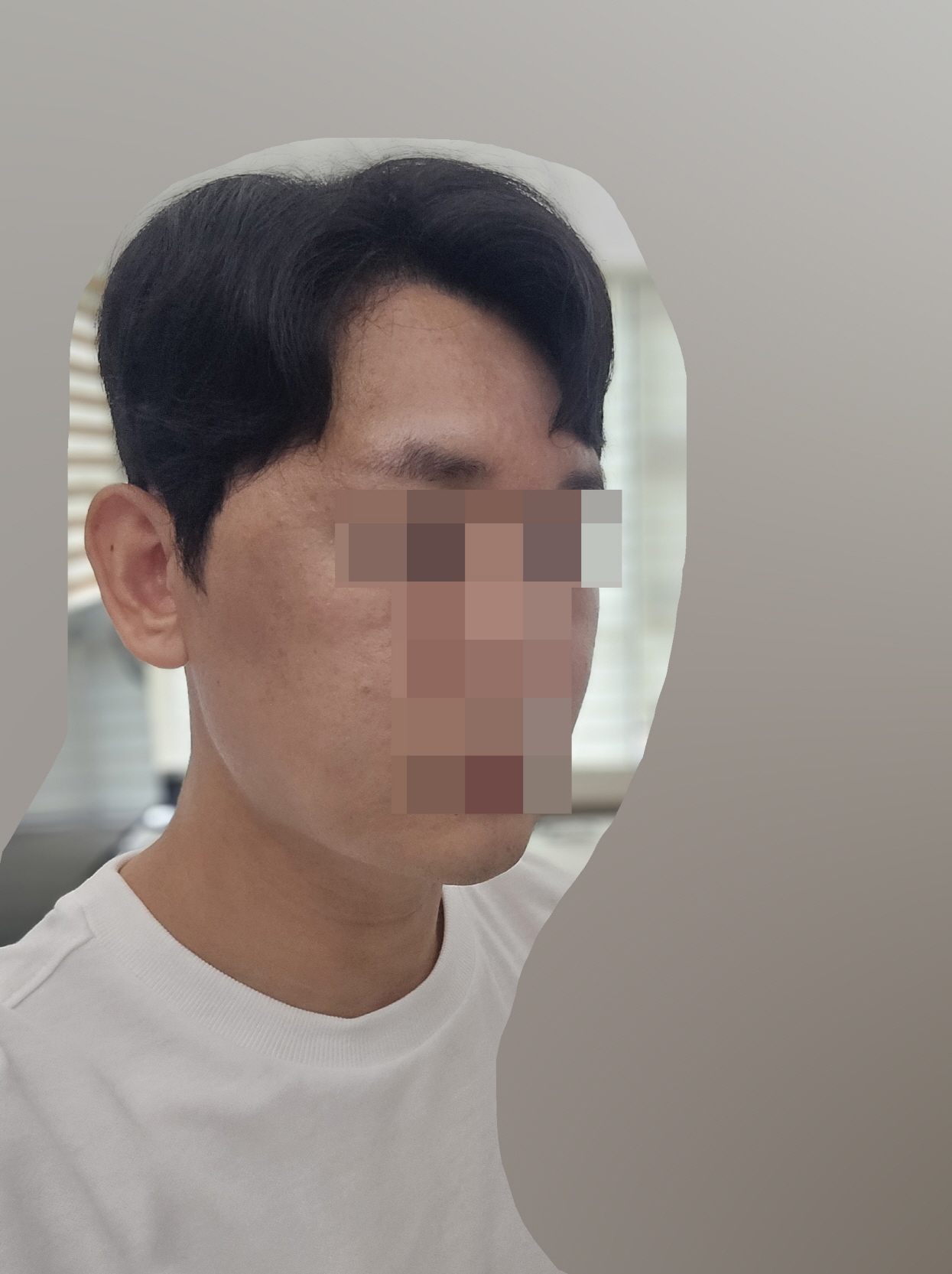 수술후기이미지