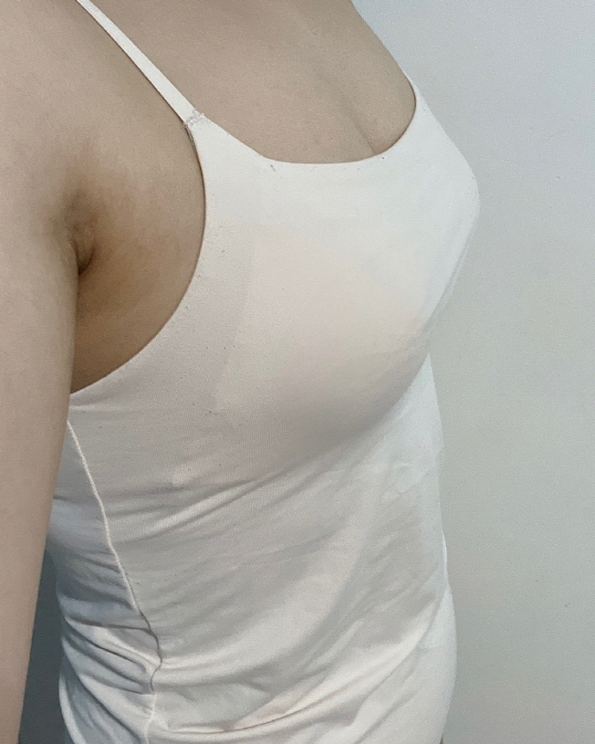 수술후기이미지