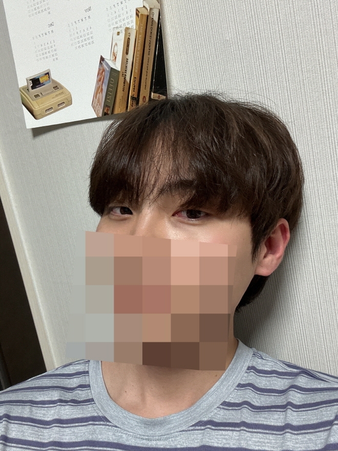 수술후기이미지