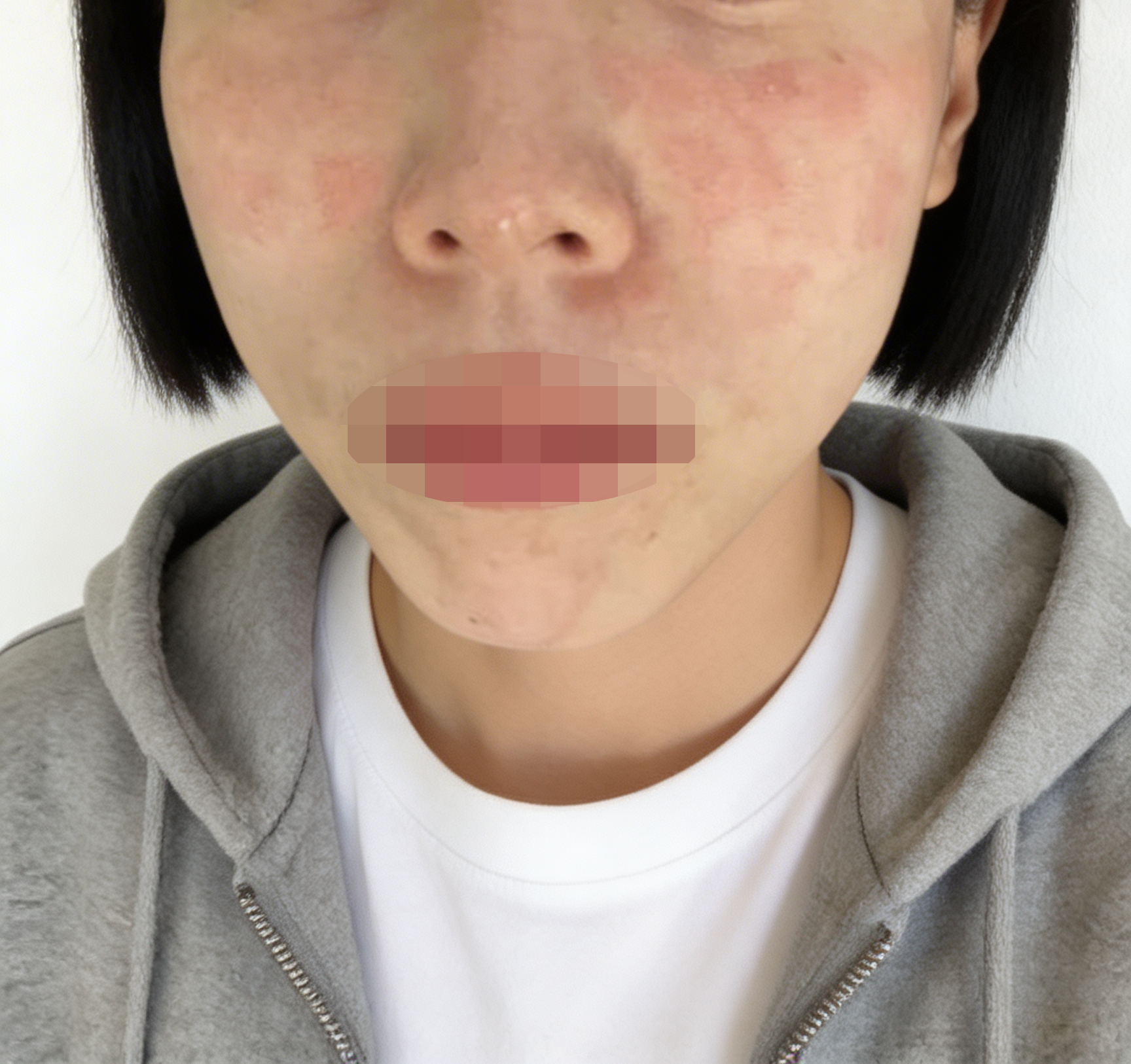 수술후기이미지