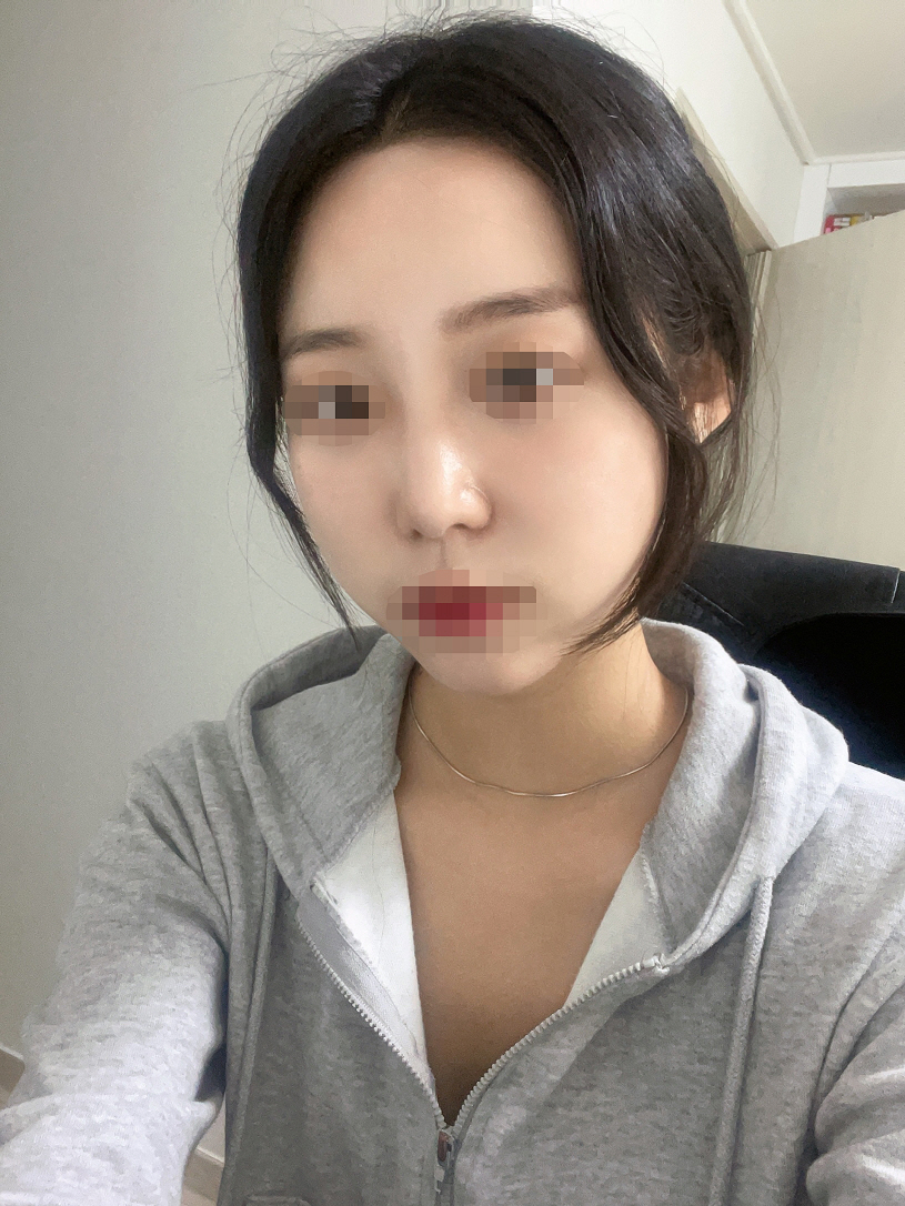 수술후기이미지