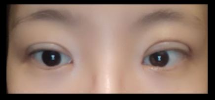 수술후기이미지