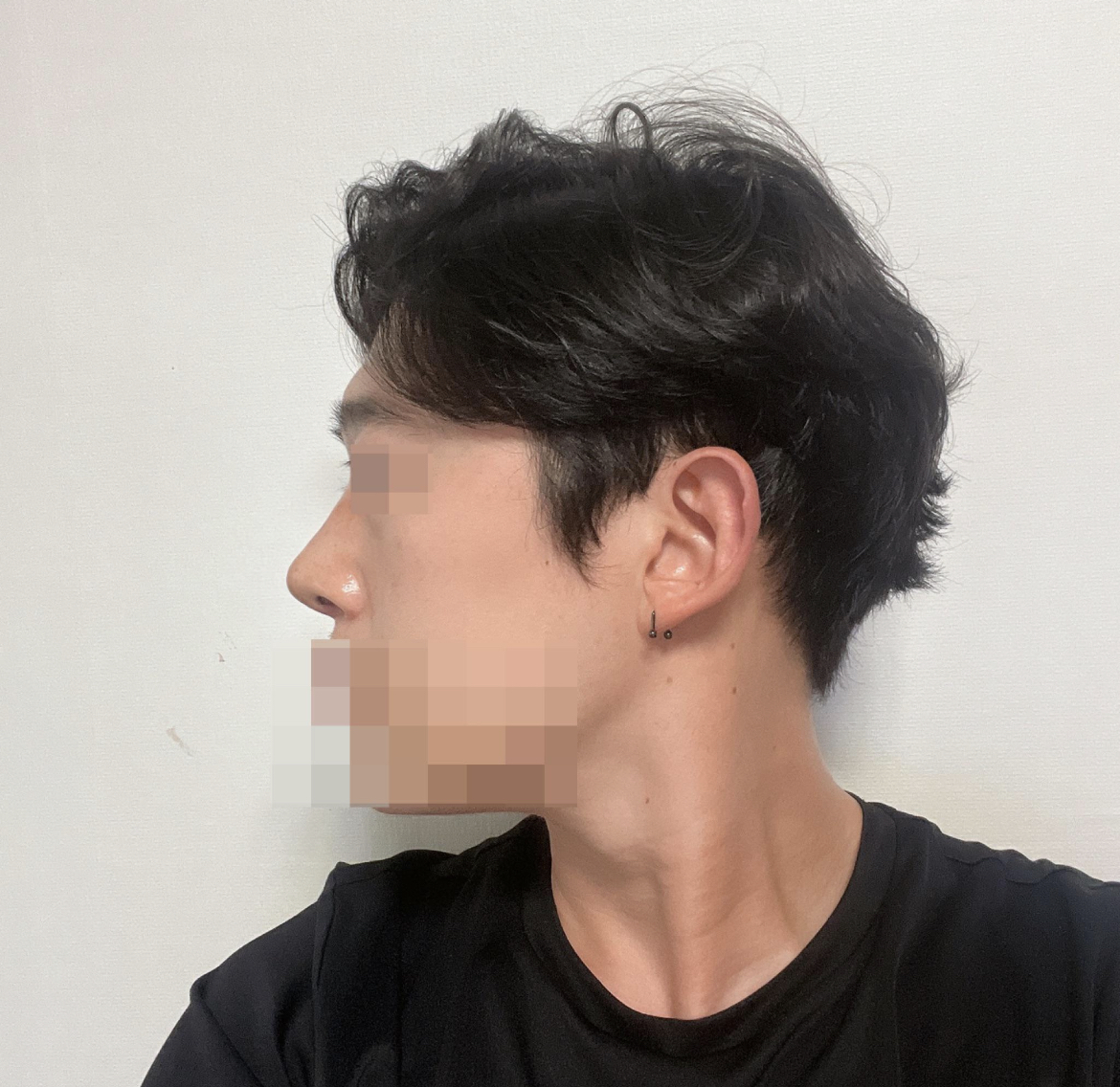 수술후기이미지