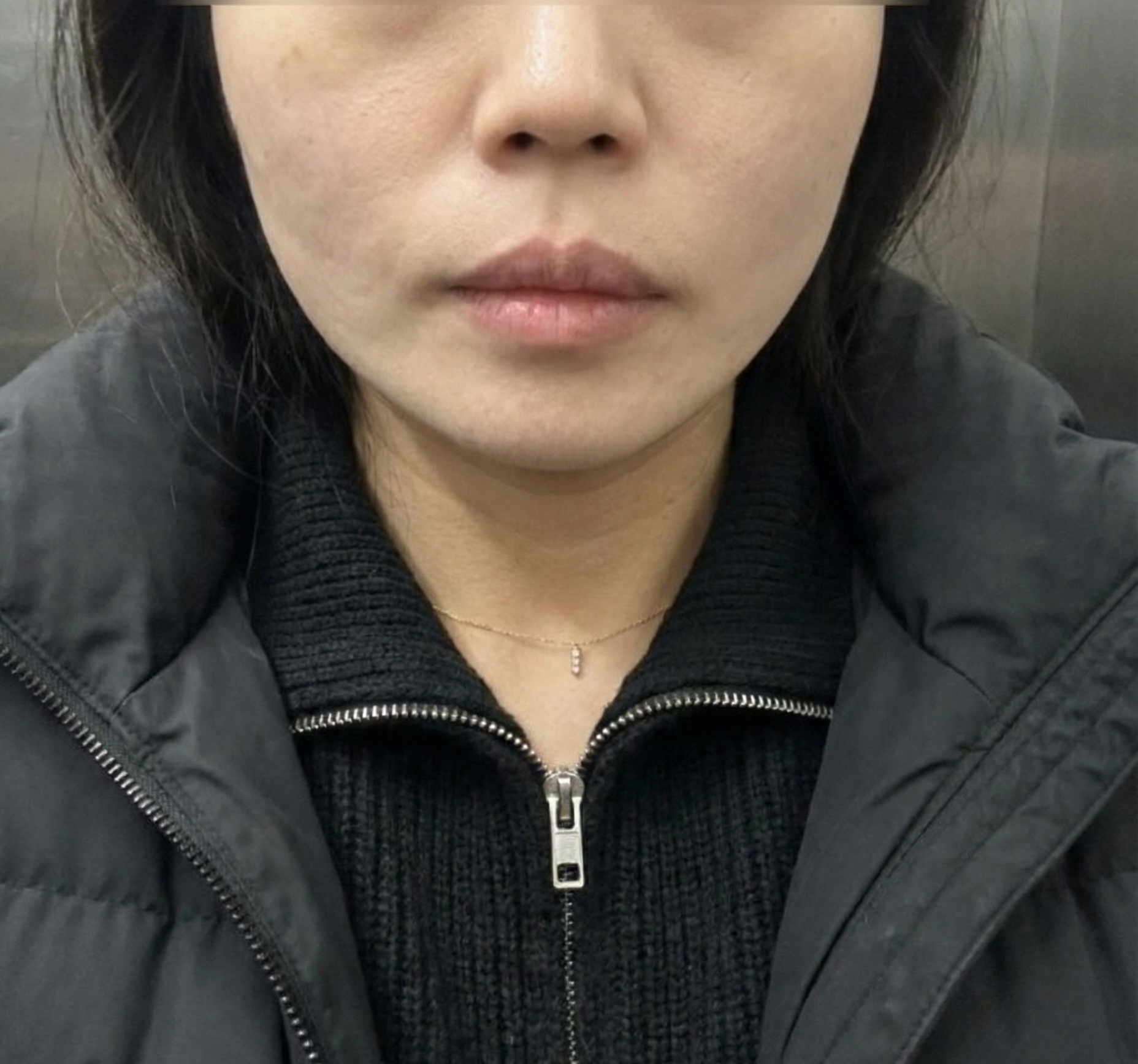 수술후기이미지