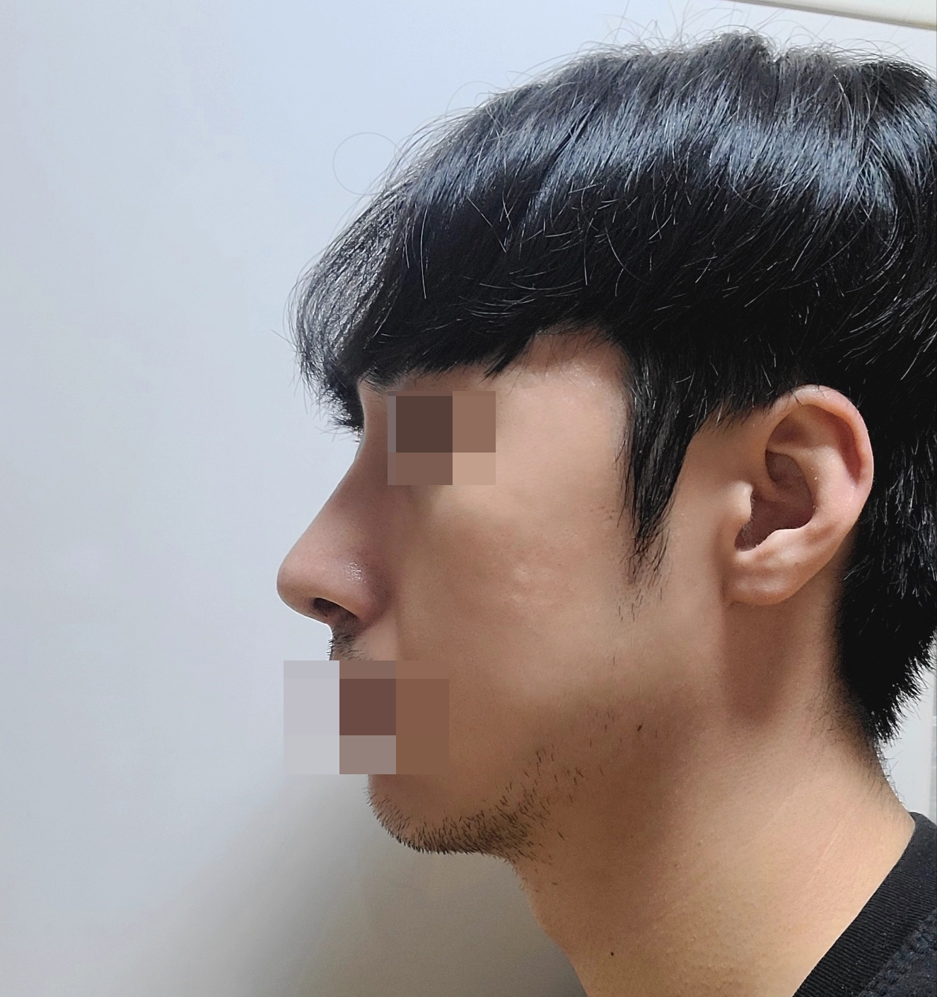 수술후기이미지