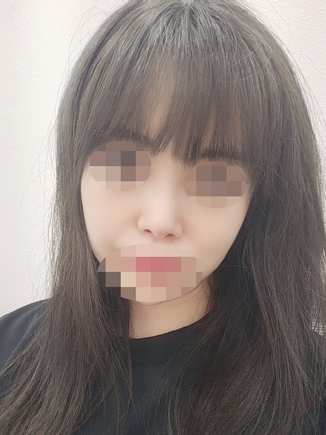 수술후기이미지