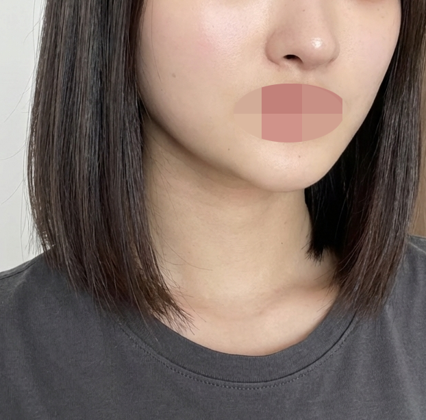 수술후기이미지