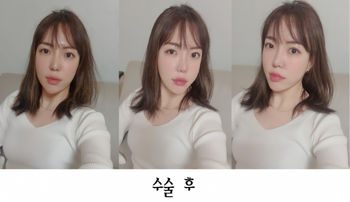 수술후기이미지