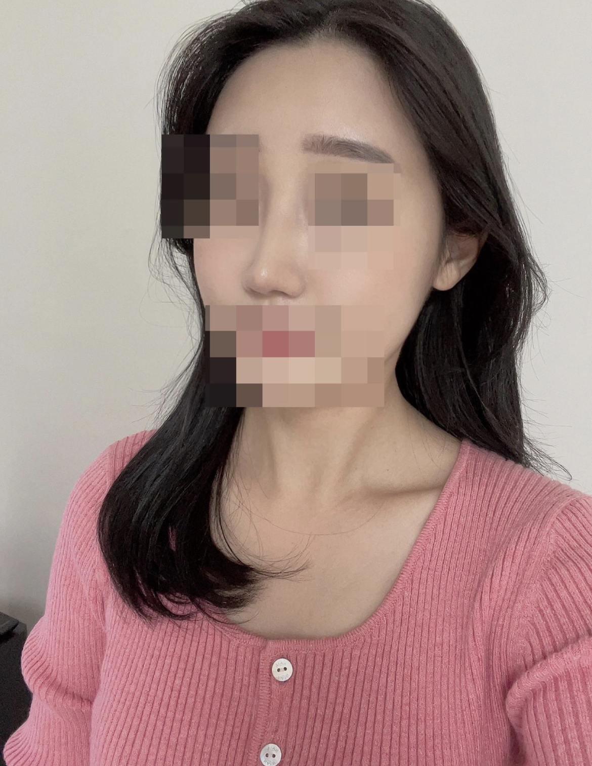 수술후기이미지