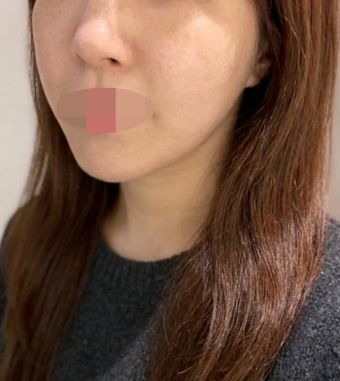 수술후기이미지