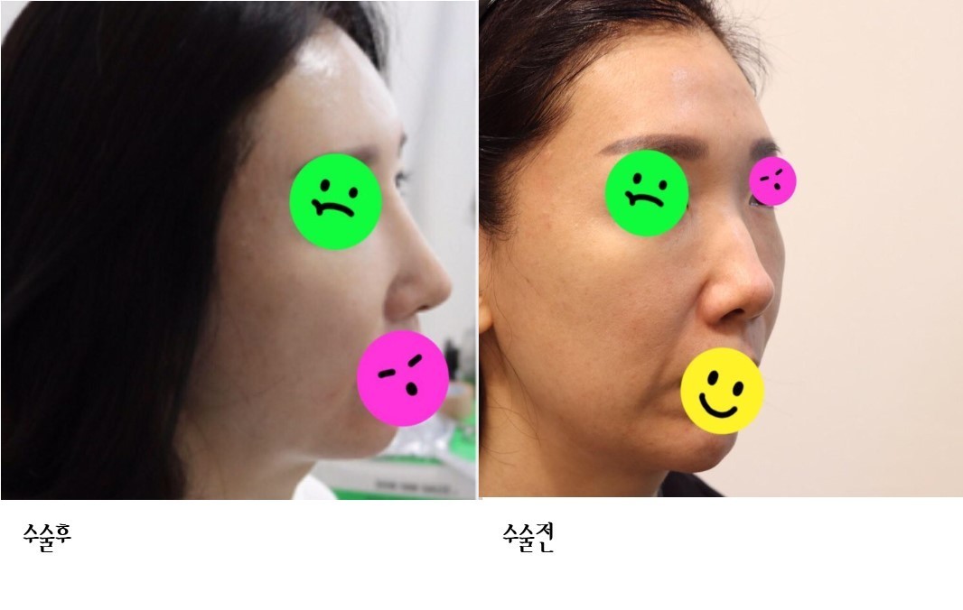 수술후기이미지